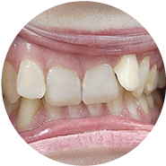 misaligned teeth